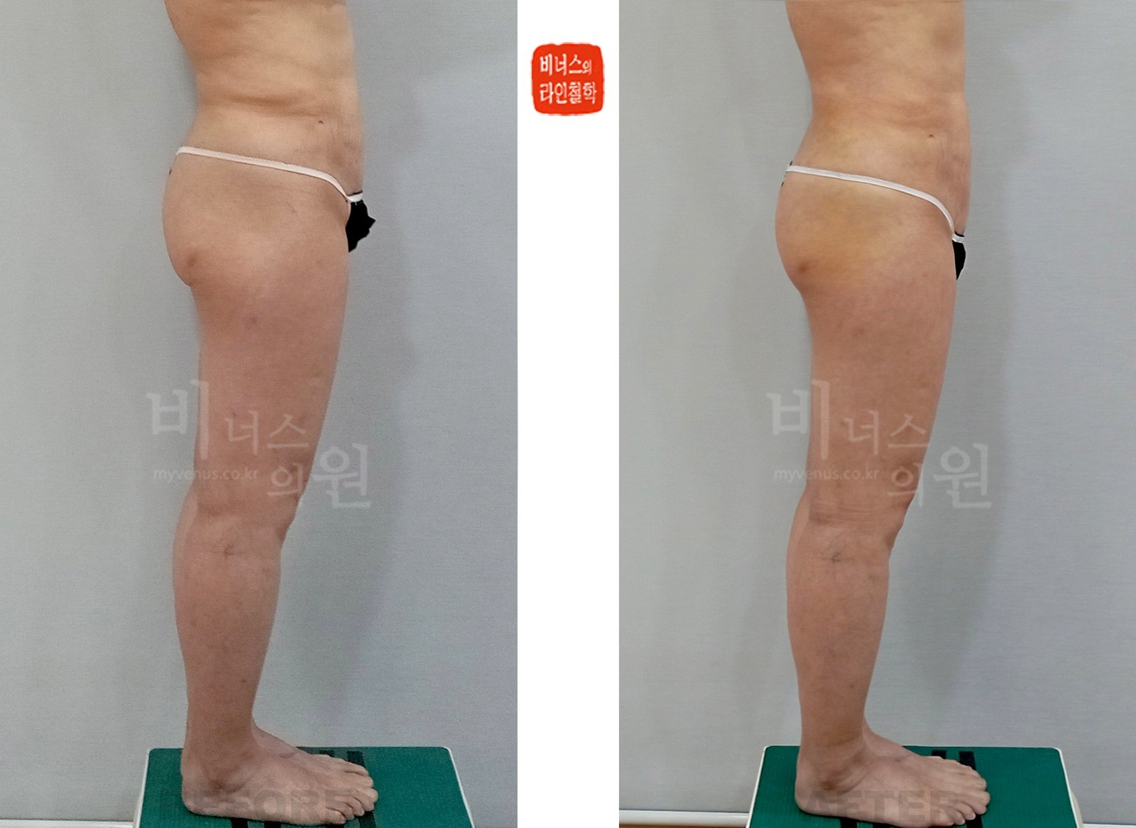 Before-and-after photos of liposuction for buttock ptosis, side view (one week after surgery)