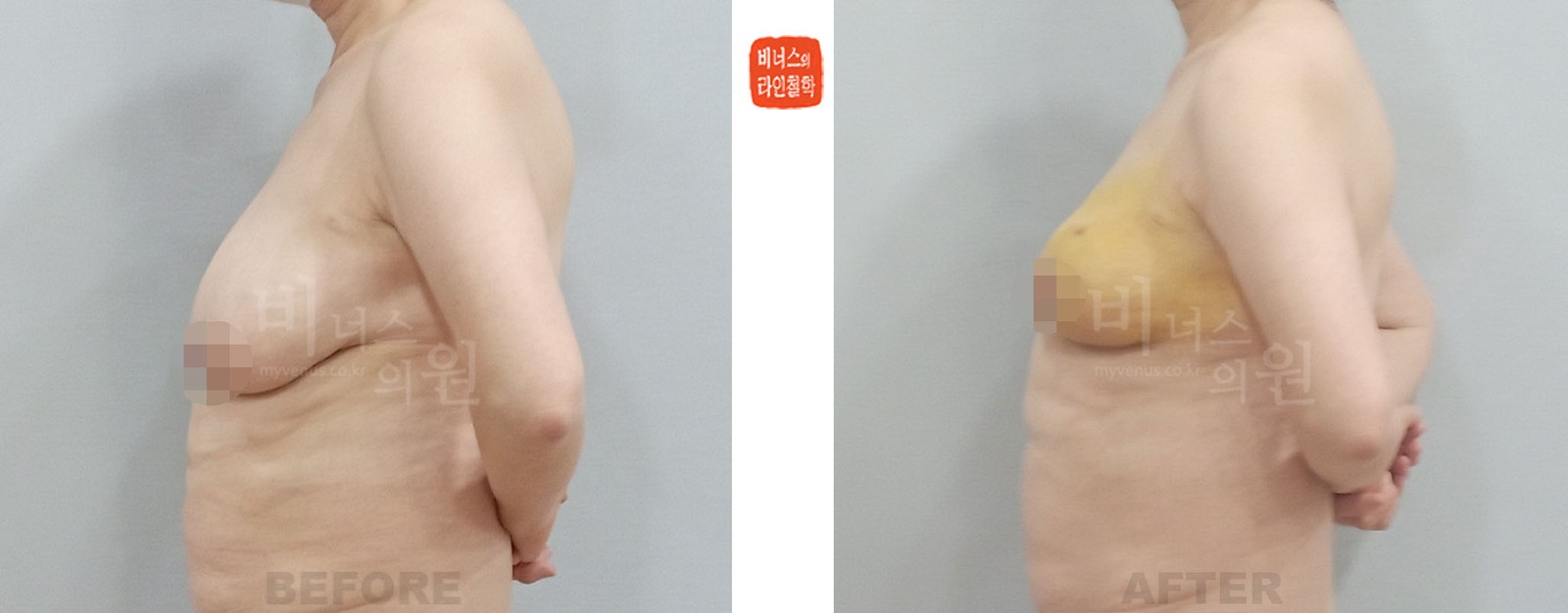Before-and-after of left-side liposuction for asymmetric breasts, left side view (1 week after surgery)