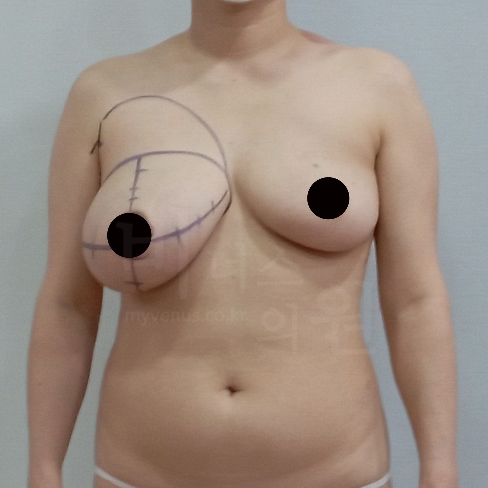 Pre-operative design for right breast liposuction, front view