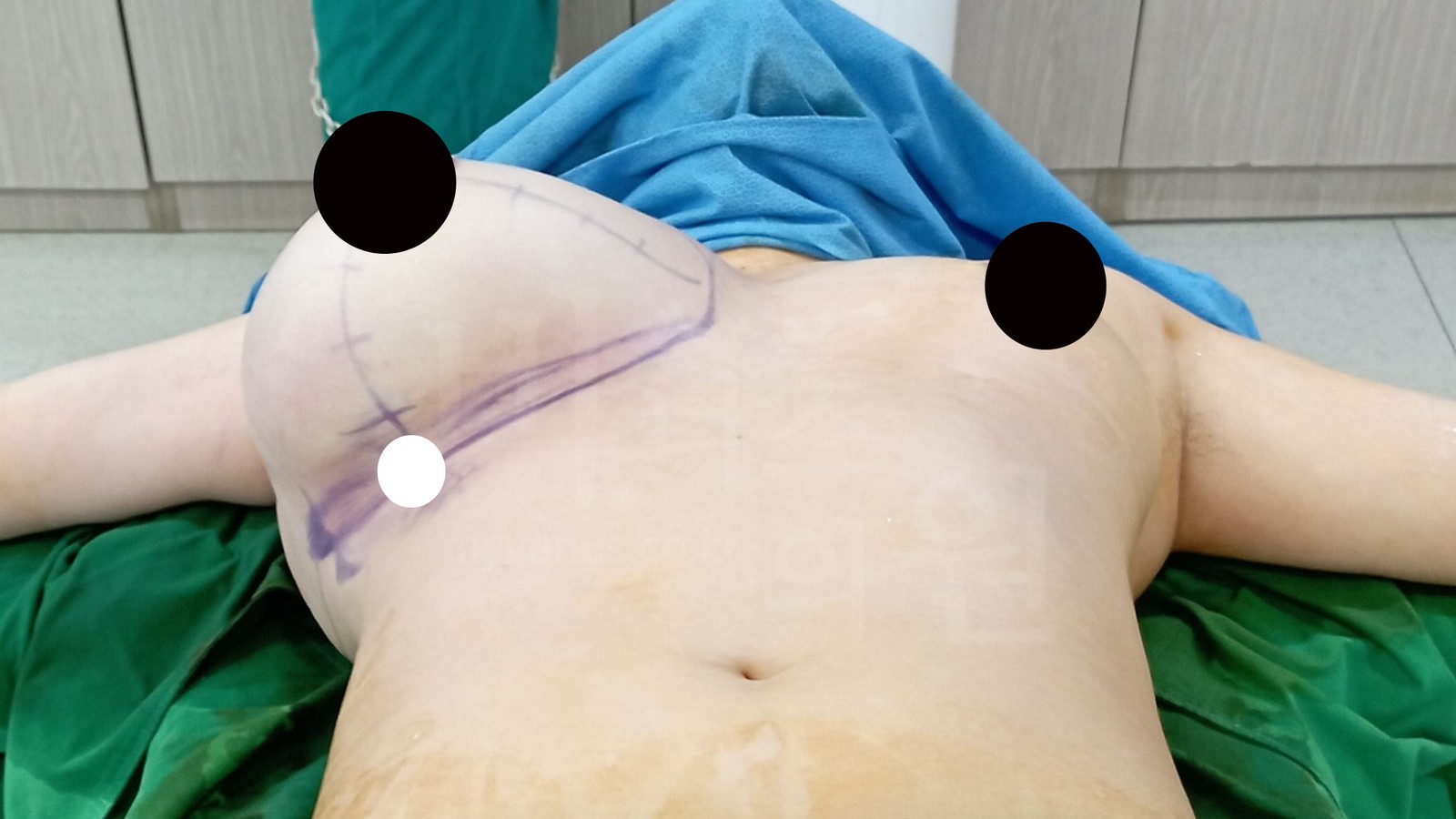 Design and markings on the right breast seen on the operating table (1)