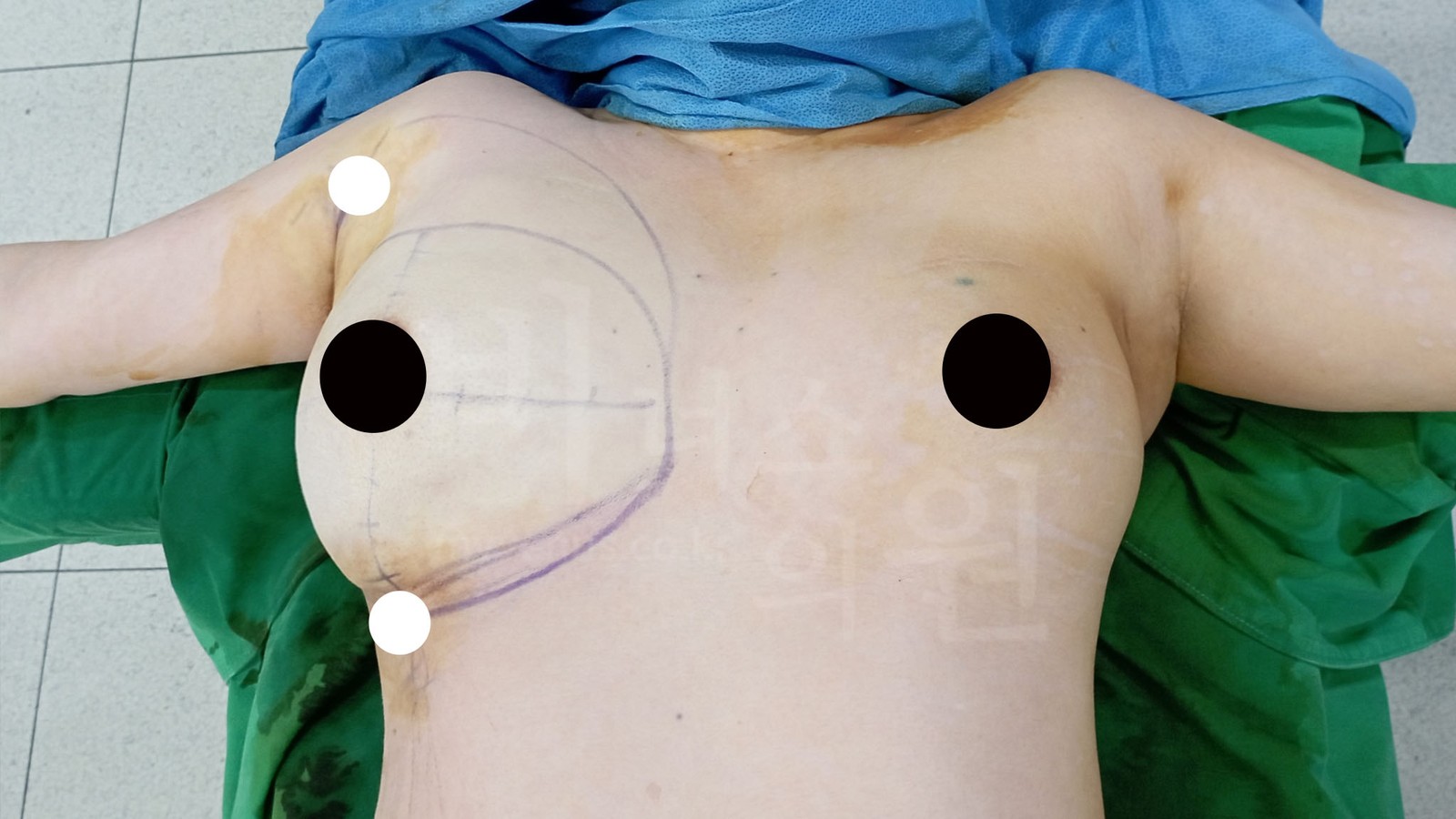 Design and markings on the right breast seen on the operating table (2)