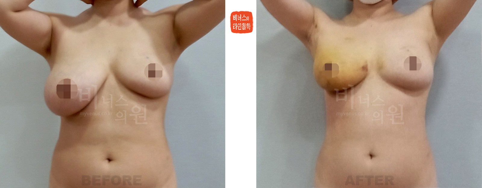 Before-and-after of right-side liposuction for asymmetric breasts, front view (1 week after surgery)