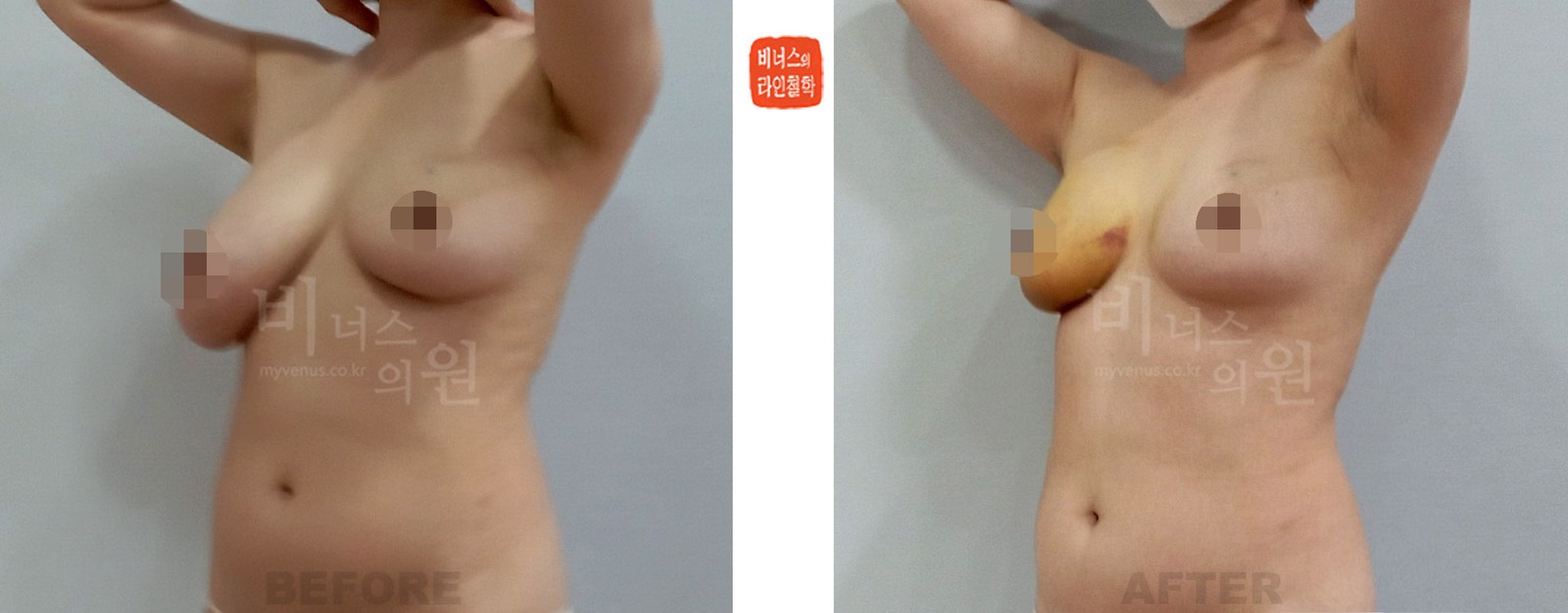 Before-and-after of right-side liposuction for asymmetric breasts, right 45-degree side view (1 week after surgery)