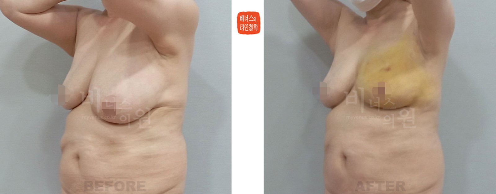 Before-and-after of left-side liposuction for asymmetric breasts, left 45-degree side view (1 week after surgery)