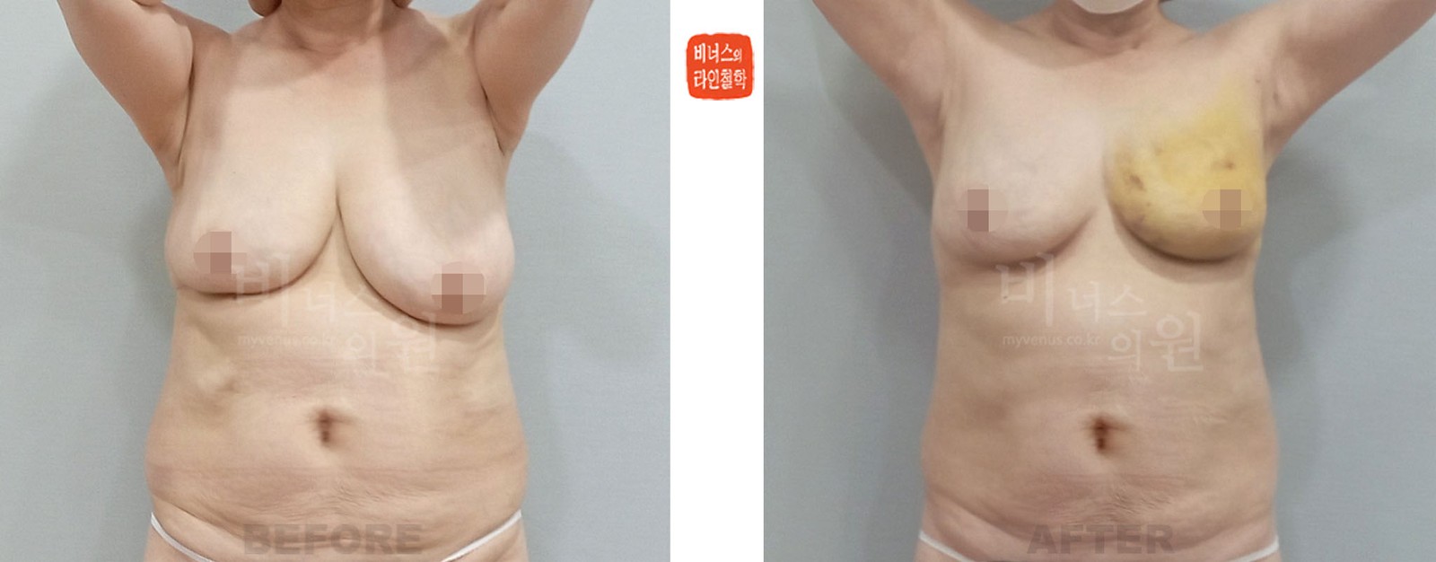 Before-and-after of left-side liposuction for asymmetric breasts, front view (1 week after surgery)