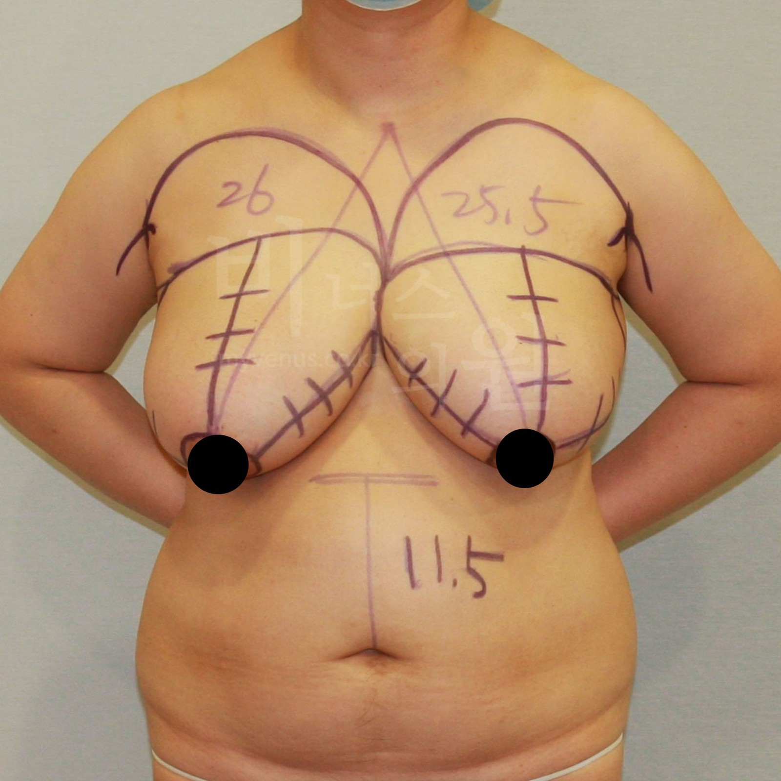 Pre-operative front view with design for breast reduction liposuction