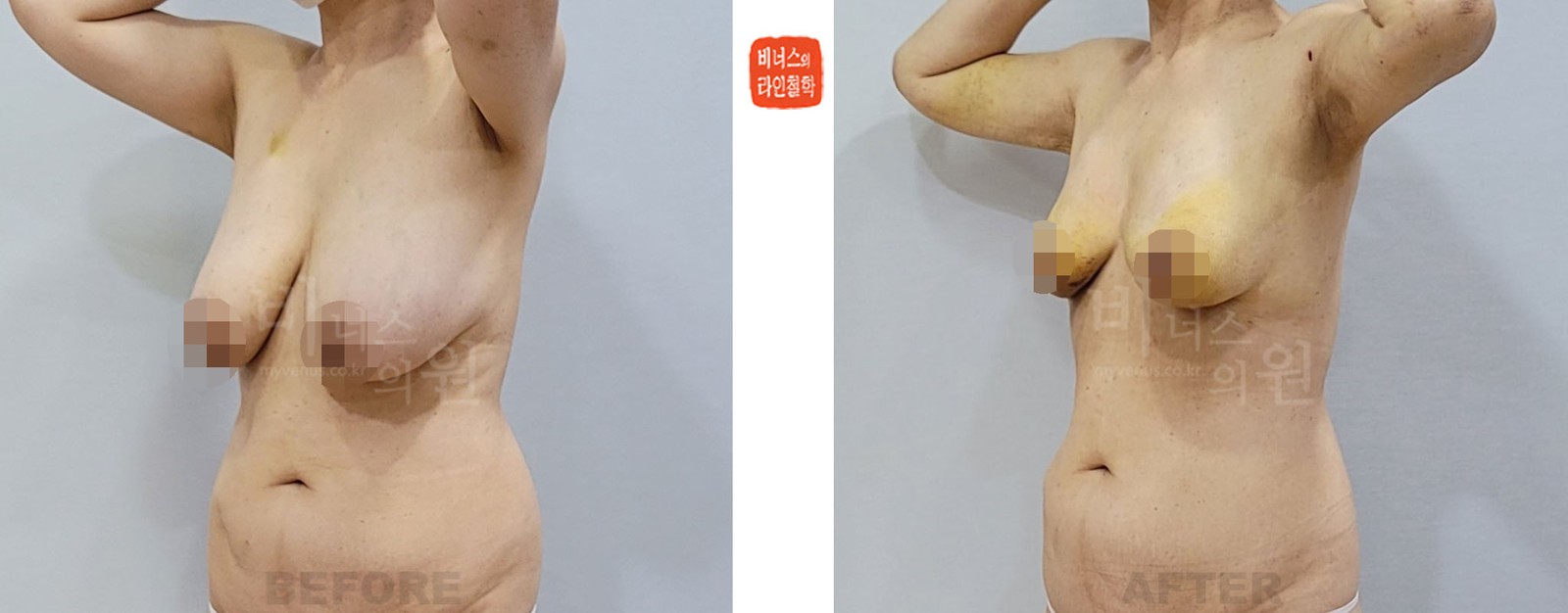 Breast reduction liposuction before-and-after photo, 45-degree oblique view (one week after surgery)