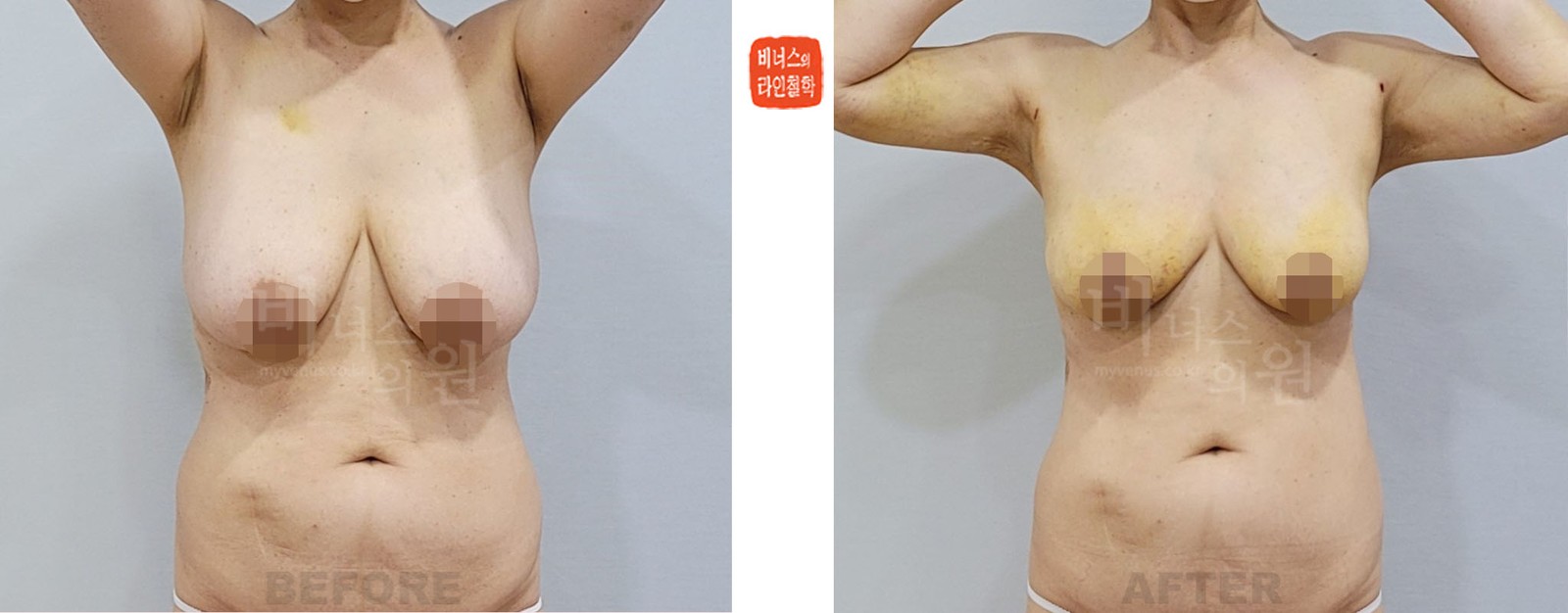 Breast reduction liposuction before-and-after photo, front view (one week after surgery)