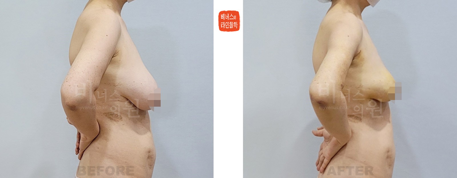 Breast reduction liposuction before-and-after photo, side view (one week after surgery)
