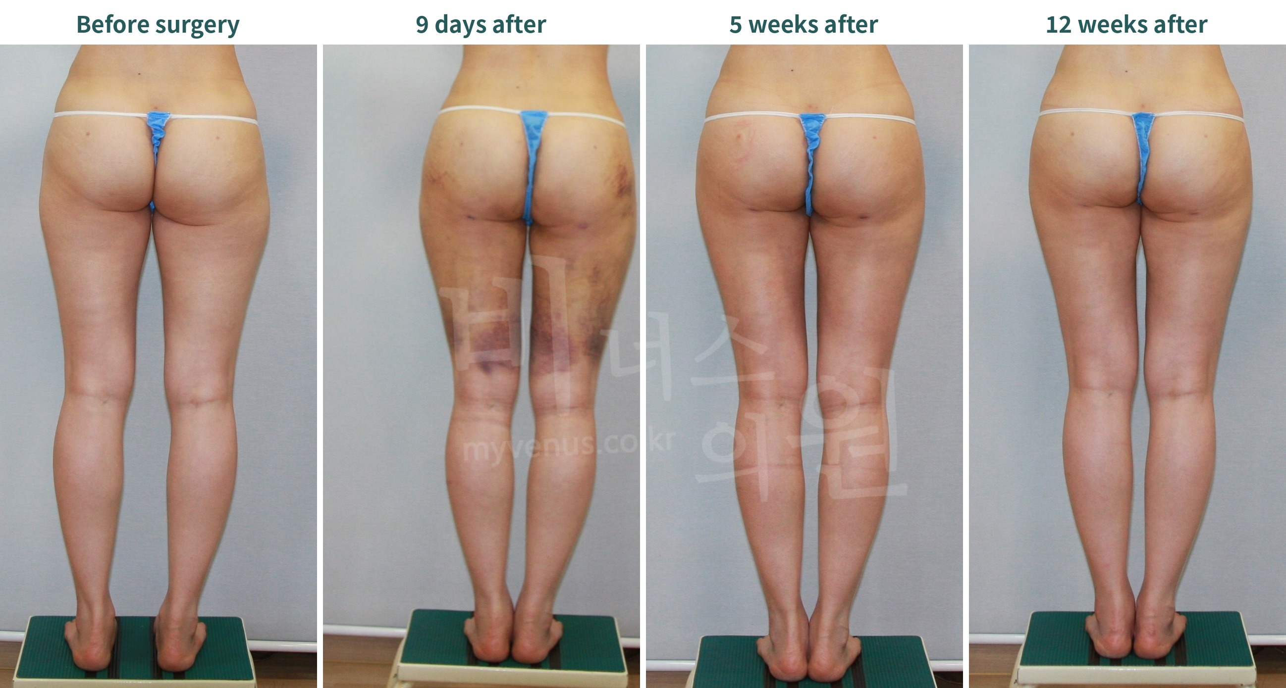 Recovery course after thigh and buttock liposuction, back view — before surgery, 9 days, 5 weeks, 12 weeks
