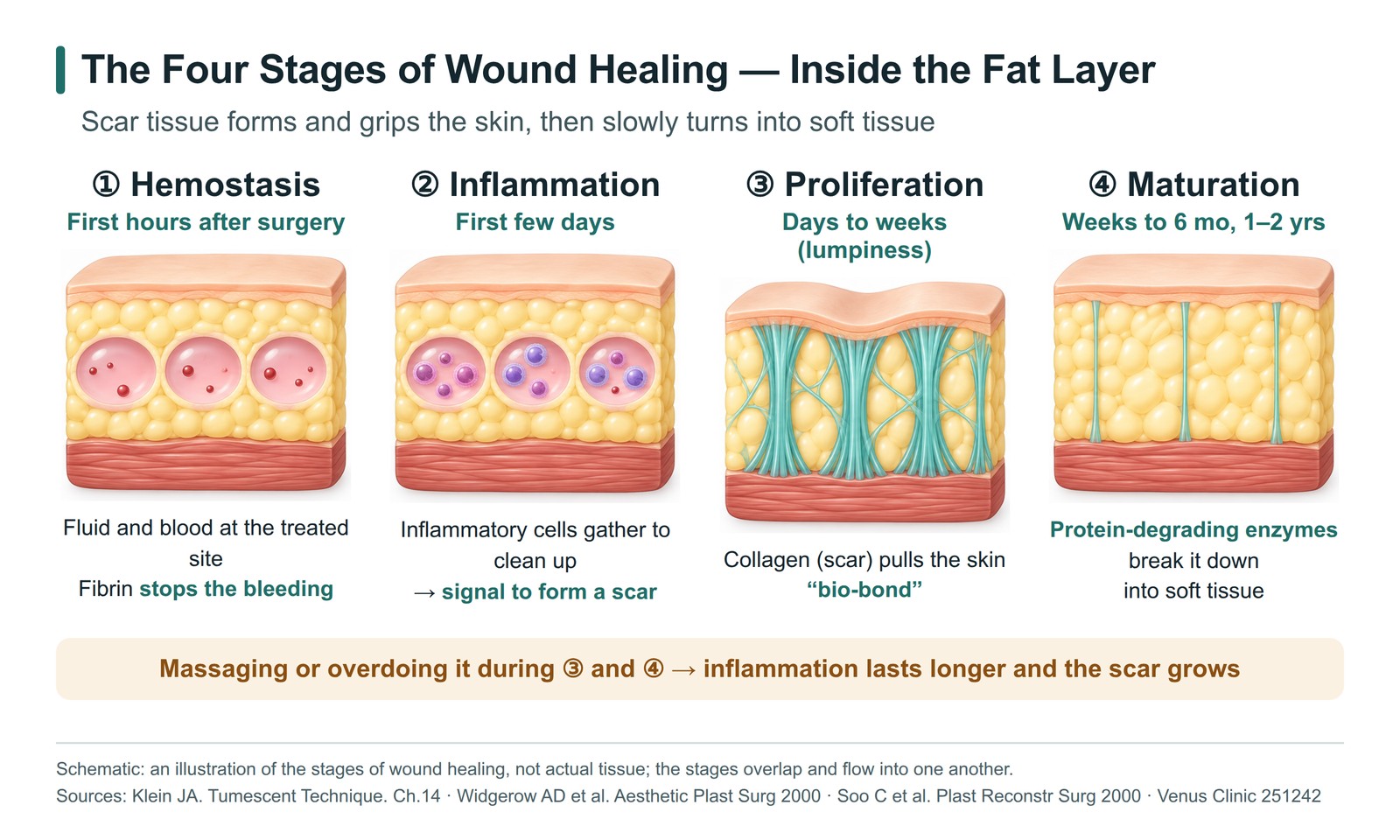 Cross-section diagram of the fat layer showing the four stages of wound healing: hemostasis, inflammation, proliferation and maturation
