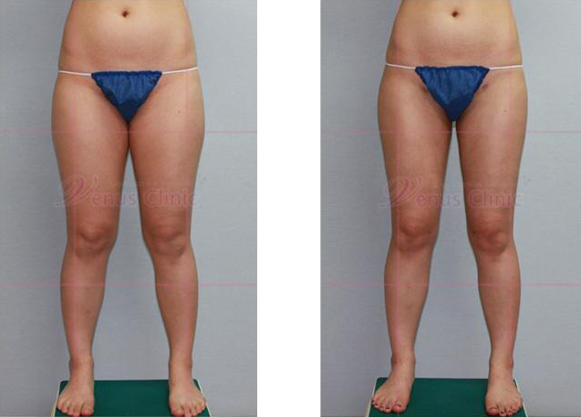 Honey thigh liposuction 1