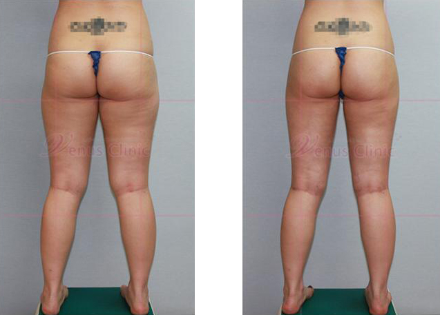 Honey thigh liposuction 3