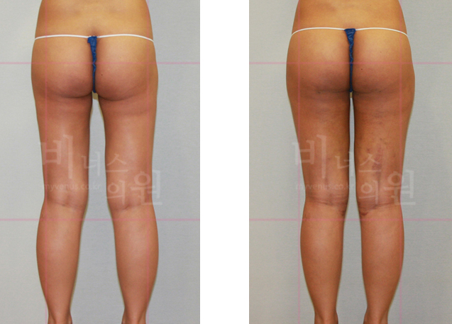 Thigh liposuction revision 2