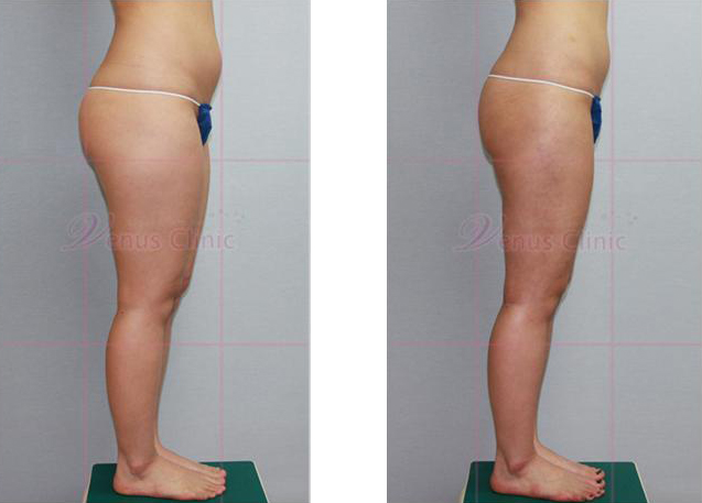 Honey thigh liposuction 2