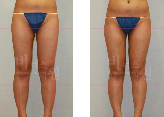 Thigh liposuction revision 1