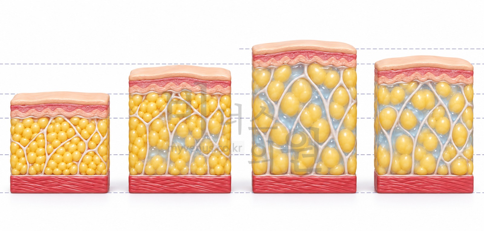 Four-stage cross-section showing the fat layer becoming swollen and firm before and after tumescent fluid infusion