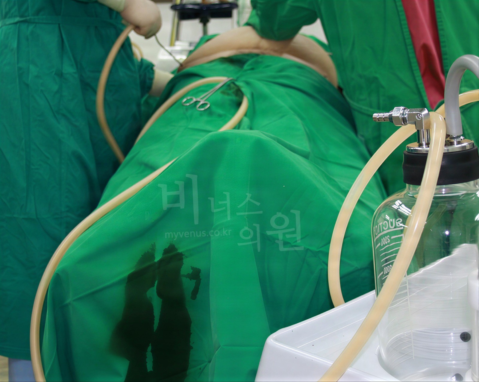 Fat flowing through the suction tube into the suction bottle during surgery