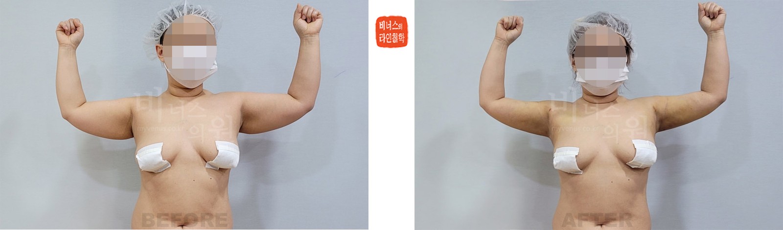 Before-and-after photos of liposuction of the entire arms and front and back armpits, front view (1 week after surgery)
