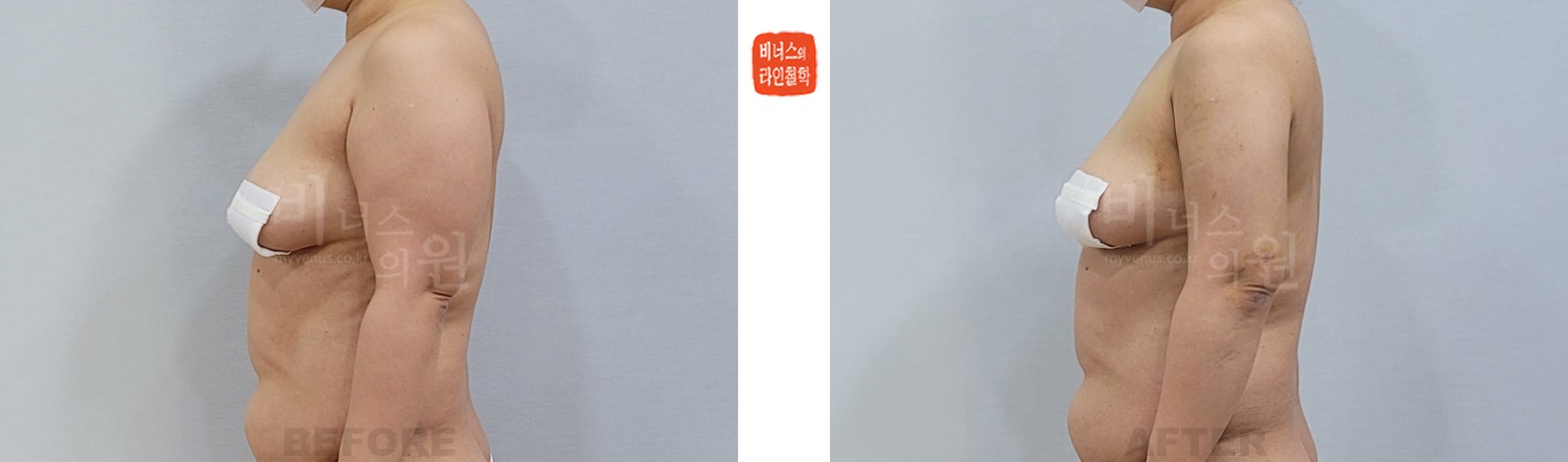 Before-and-after photos of liposuction of the entire arms and front and back armpits, side view (1 week after surgery)