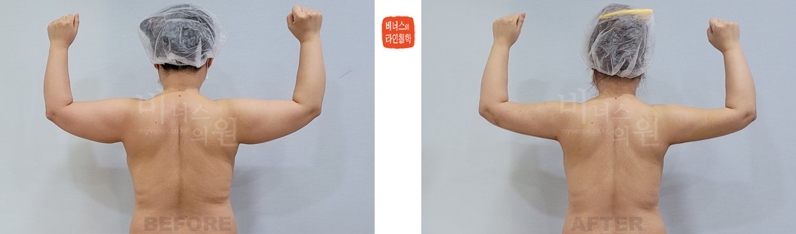 Before-and-after photos of liposuction of the entire arms and front and back armpits, back view (1 week after surgery)