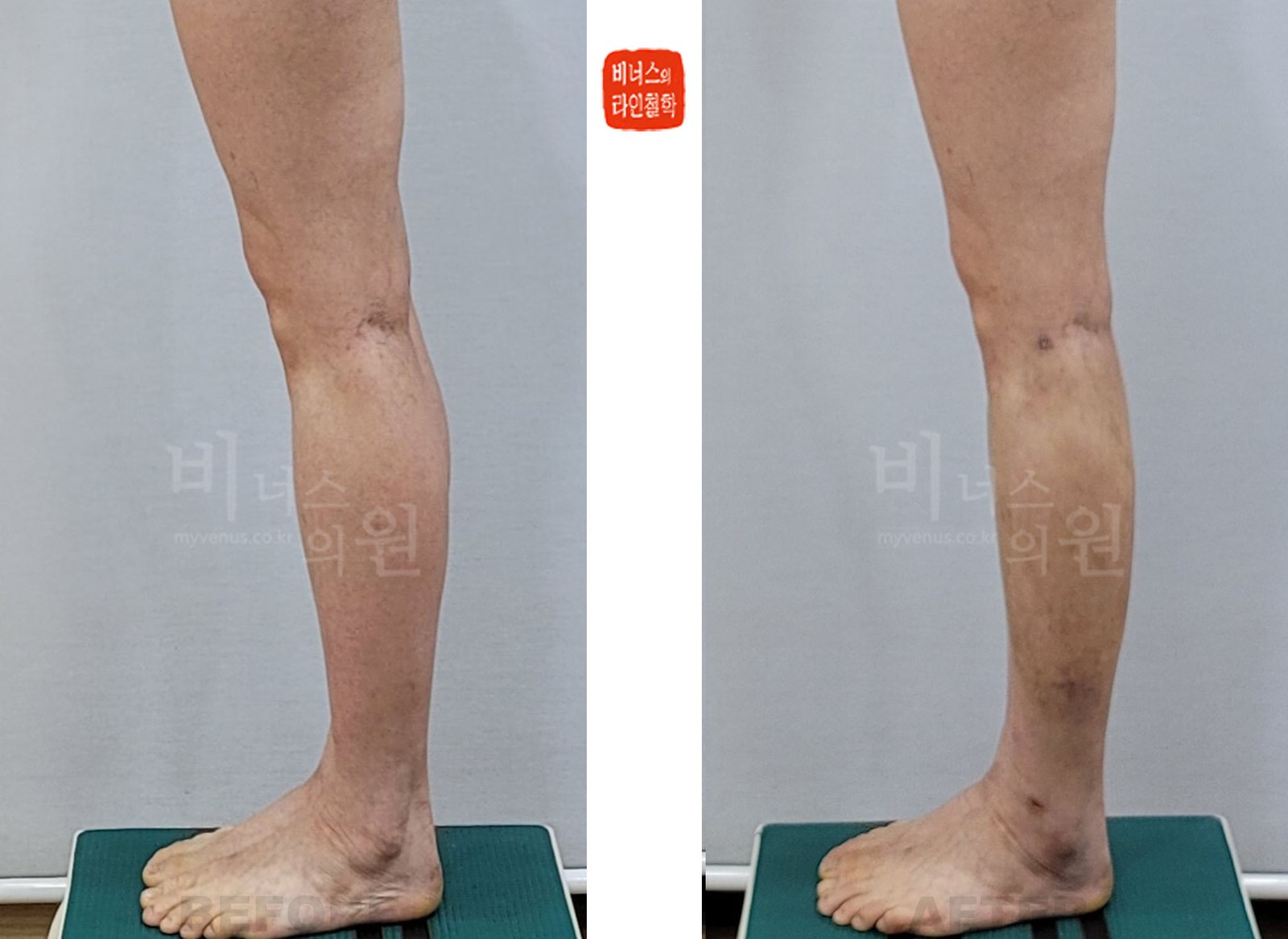 Calf liposuction before-and-after, case 1, side view (10 days after surgery)
