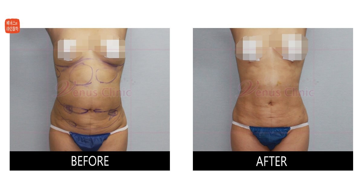 Before-and-after photos of revision surgery correcting upper abdominal under-resection and localized over-resection with liposuction
