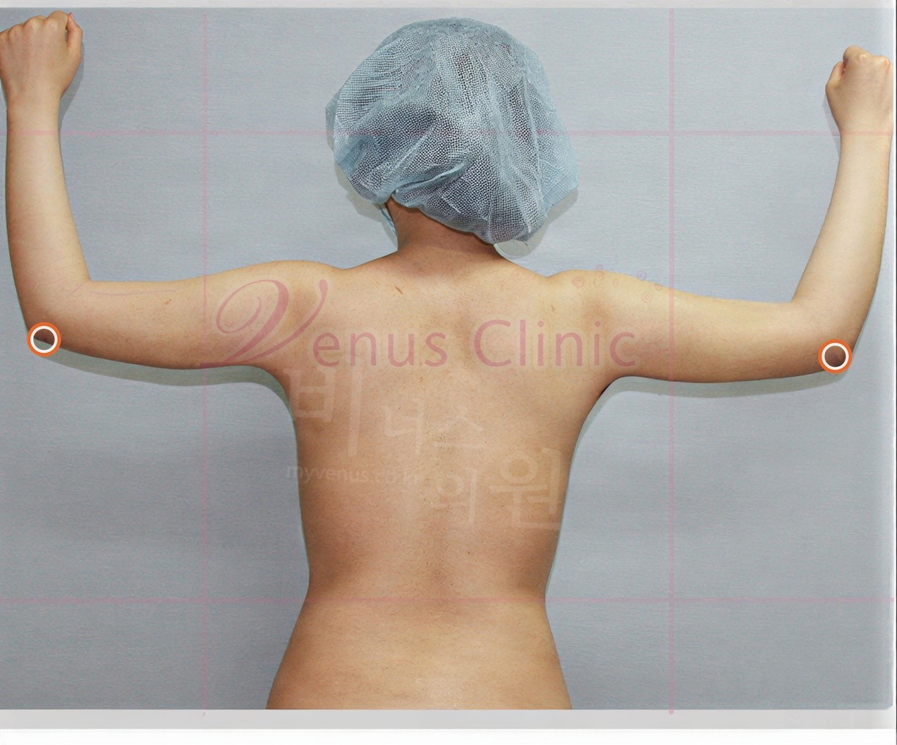 Incision site example — rear photo one week after arm and back liposuction, with the small incision site mark at the elbow circled