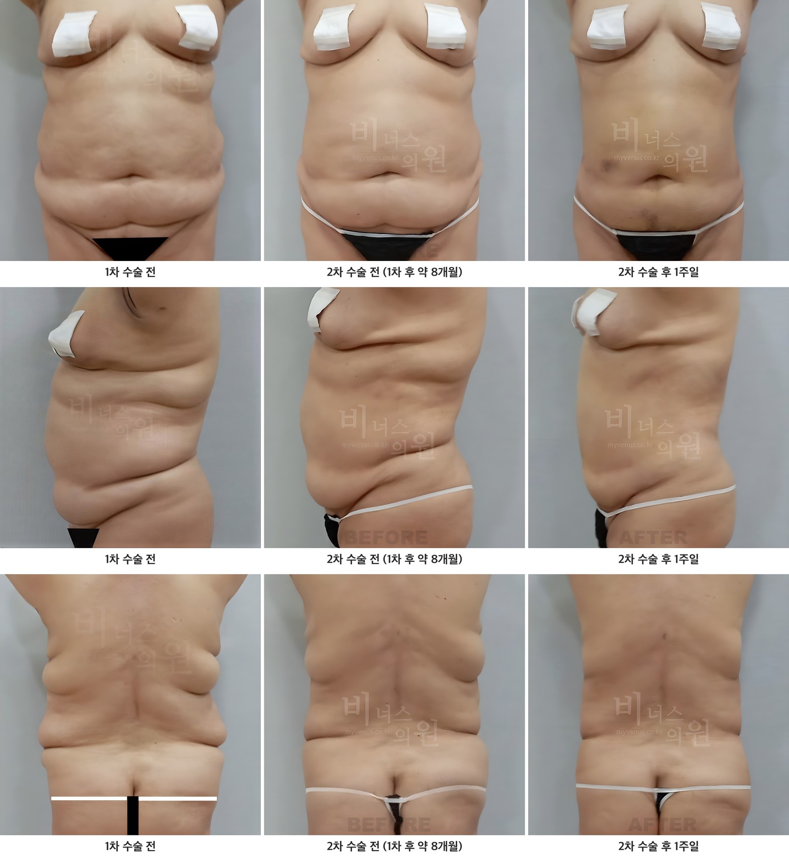 Case 1 of secondary abdominal liposuction before-and-after photos — front, side, and back views before the first surgery, before the secondary liposuction, and 1 week after the secondary liposuction
