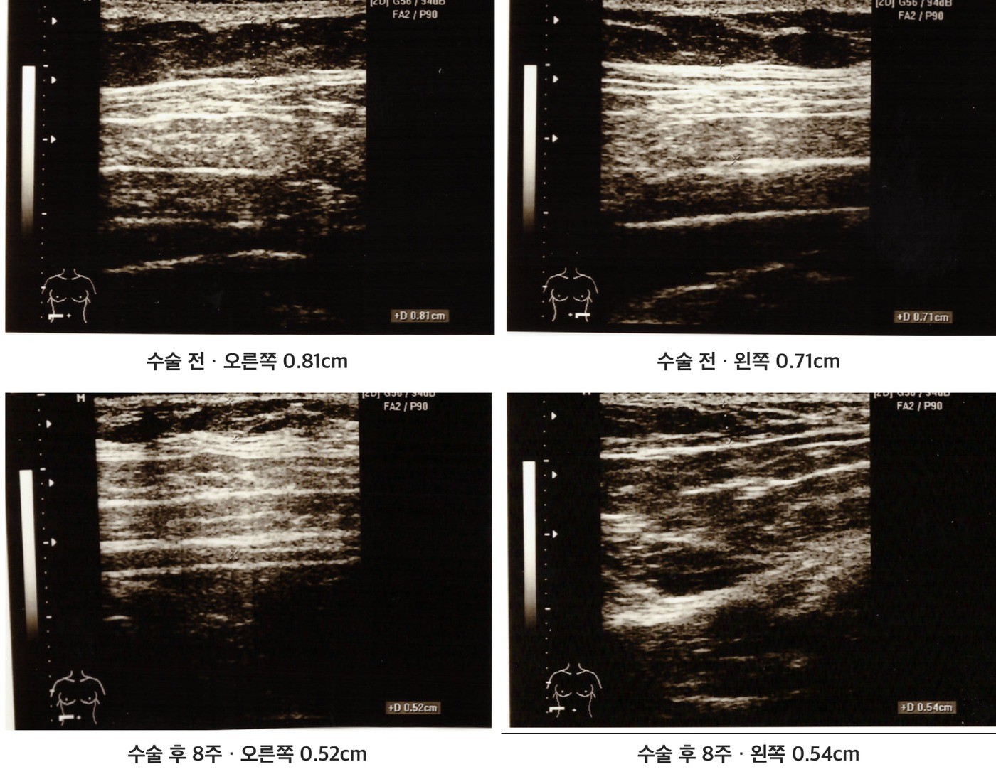 Ultrasound images comparing flank fat-layer thickness before liposuction and 8 weeks after surgery