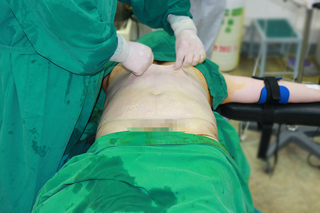 Pinch test after liposuction