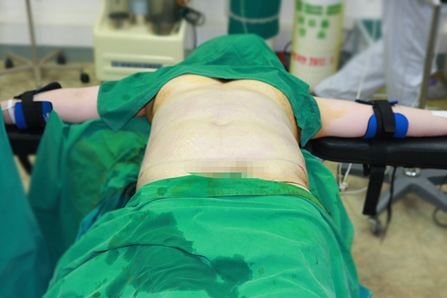 Pinch test after liposuction