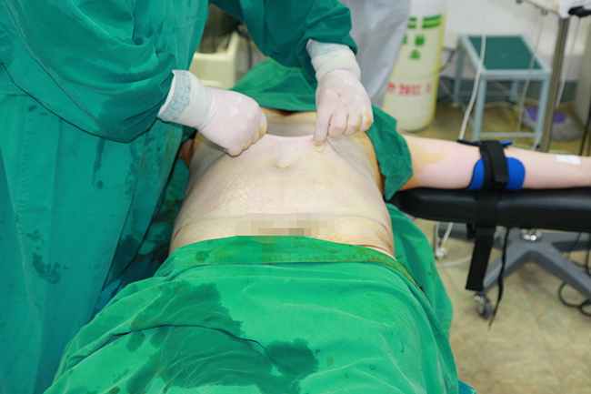 Pinch test after liposuction