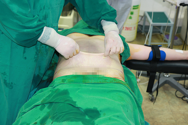 Pinch test after liposuction