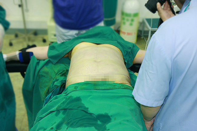 Pinch test after liposuction