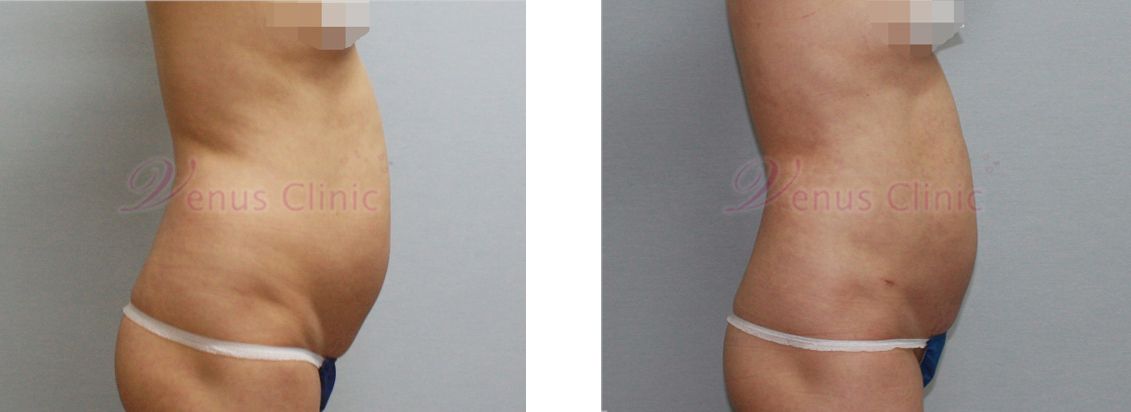Before and after liposuction: middle-aged woman with visceral obesity 3