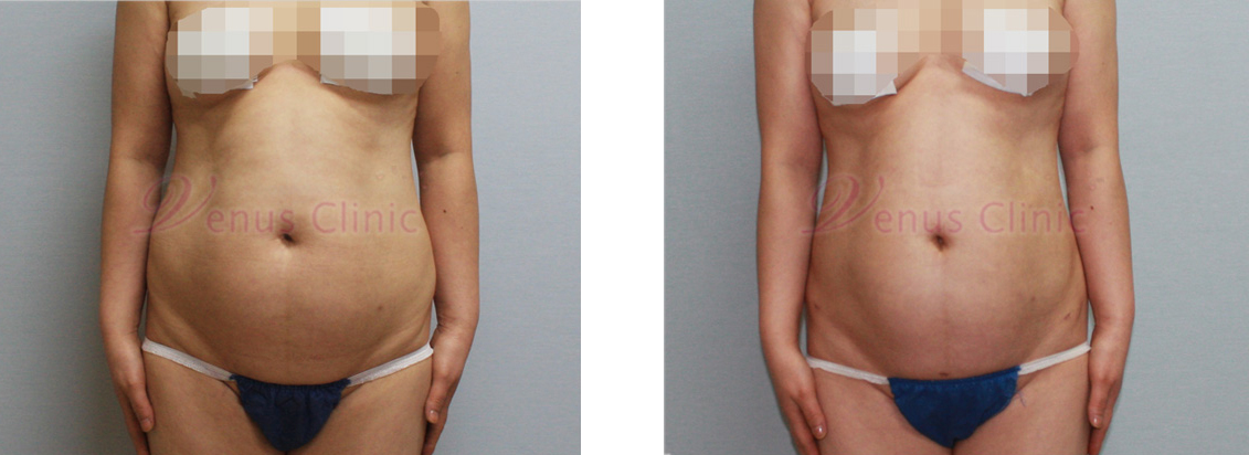 Before and after liposuction: middle-aged woman with visceral obesity 1