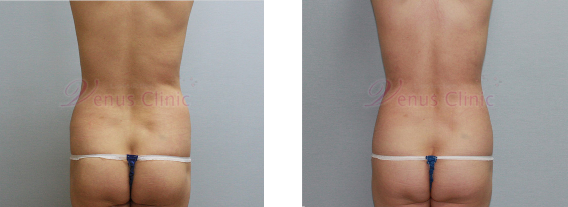 Before and after liposuction: middle-aged woman with visceral obesity 5