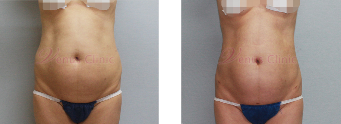 Before and after liposuction: middle-aged woman with visceral obesity 2