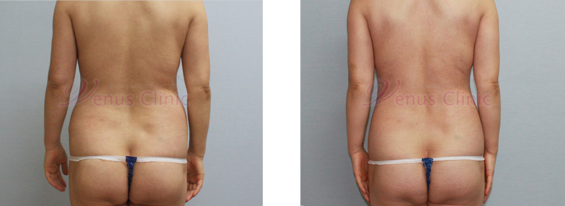 Before and after liposuction: middle-aged woman with visceral obesity 4