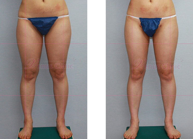 Before-and-after photos of balanced thigh liposuction