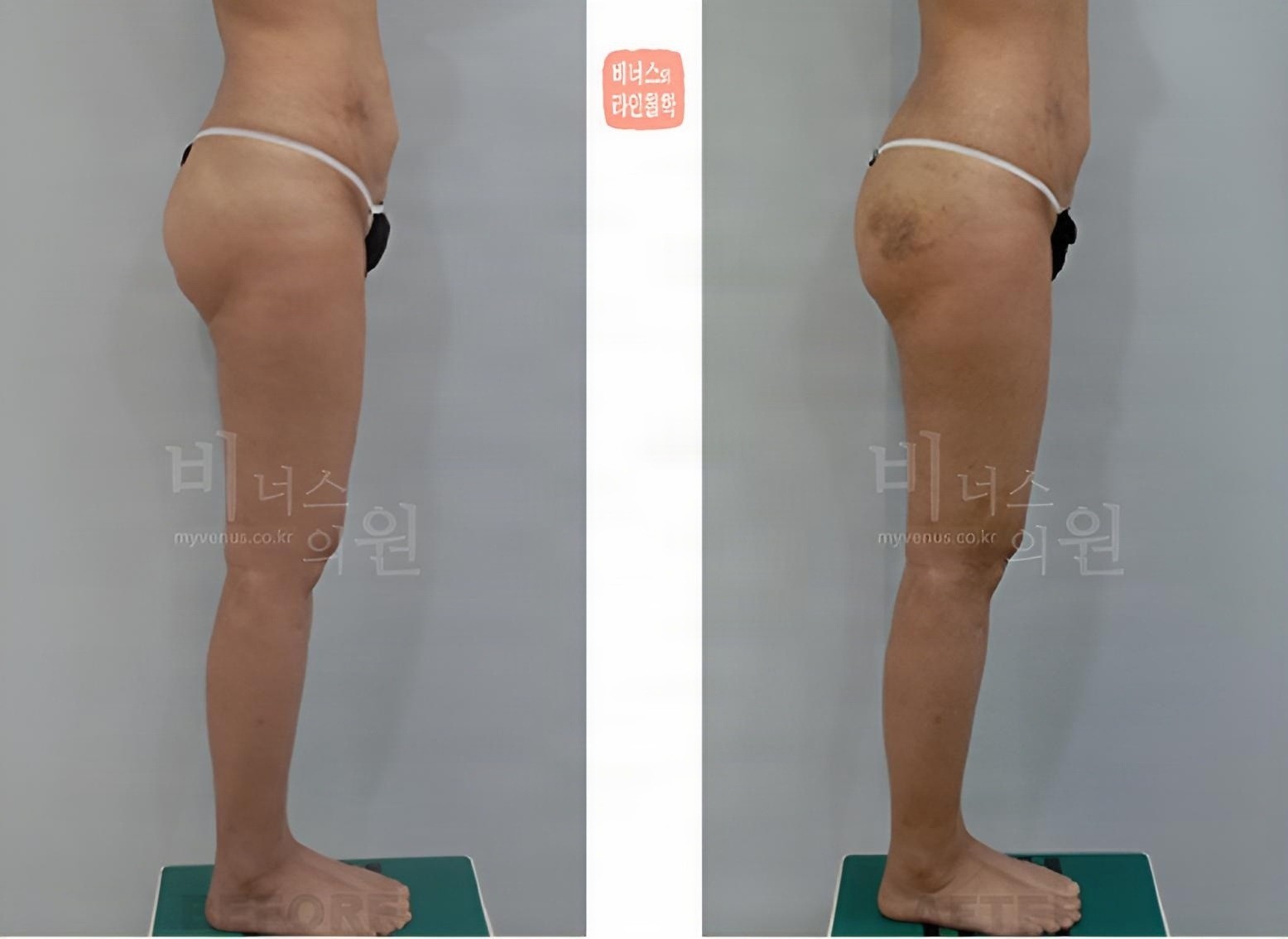Buttock volume-up liposuction before-and-after photo, right side view (about 2 weeks after surgery)
