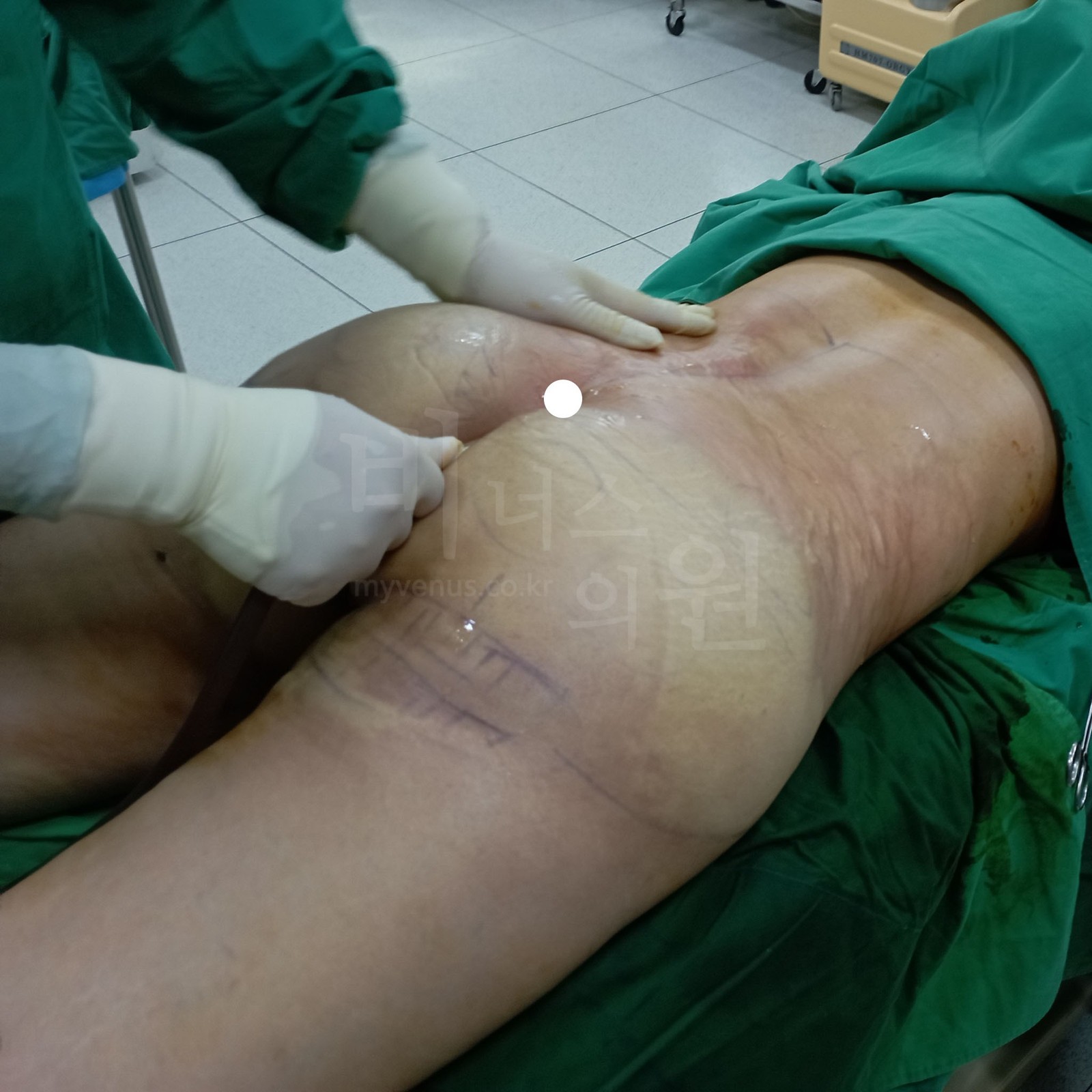 Venus Clinic surgery scene — inserting the cannula by hand along the curve of the lower buttock