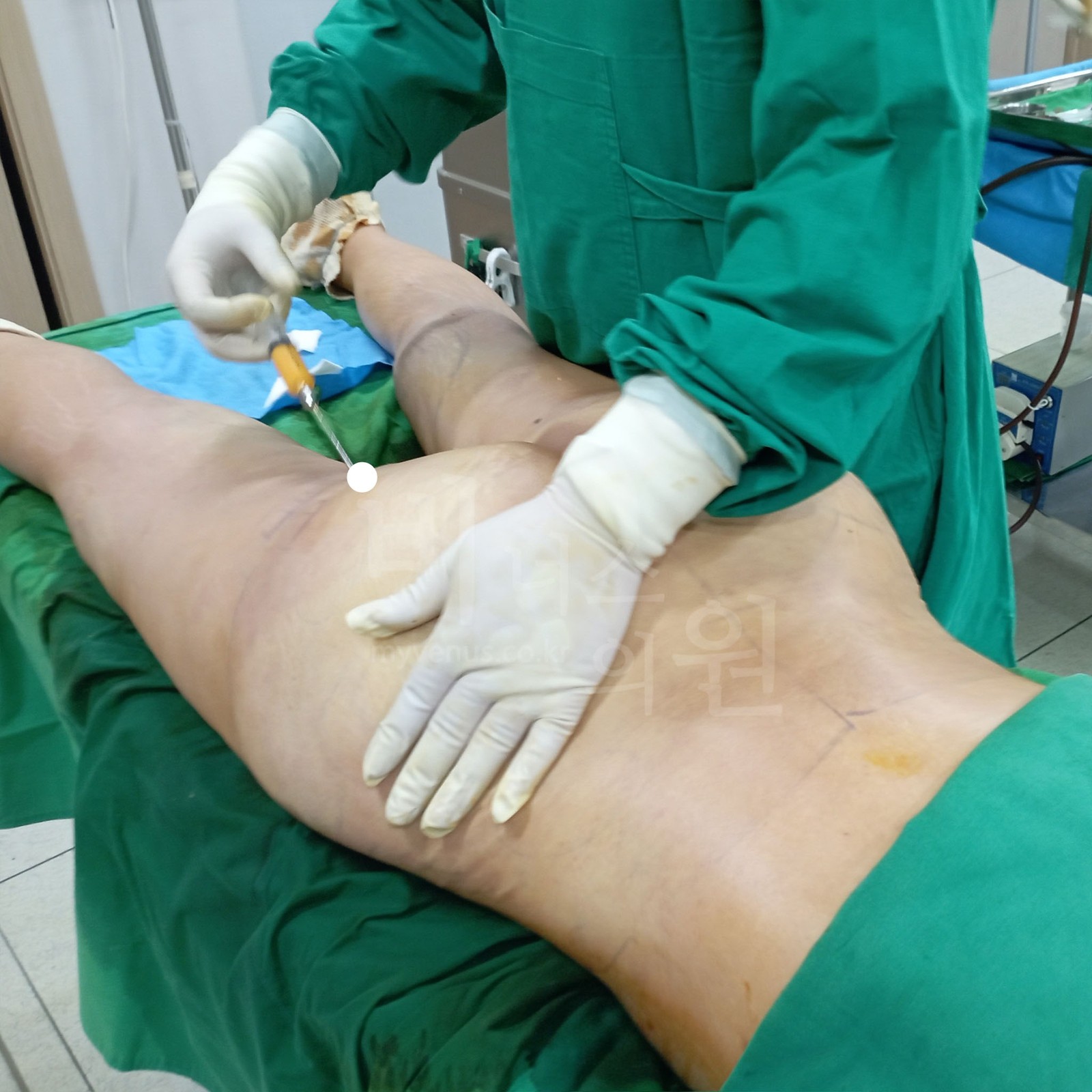Venus Clinic surgery scene — holding the tissue with one hand and inserting the cannula with the other to suction the lower buttock and upper thigh