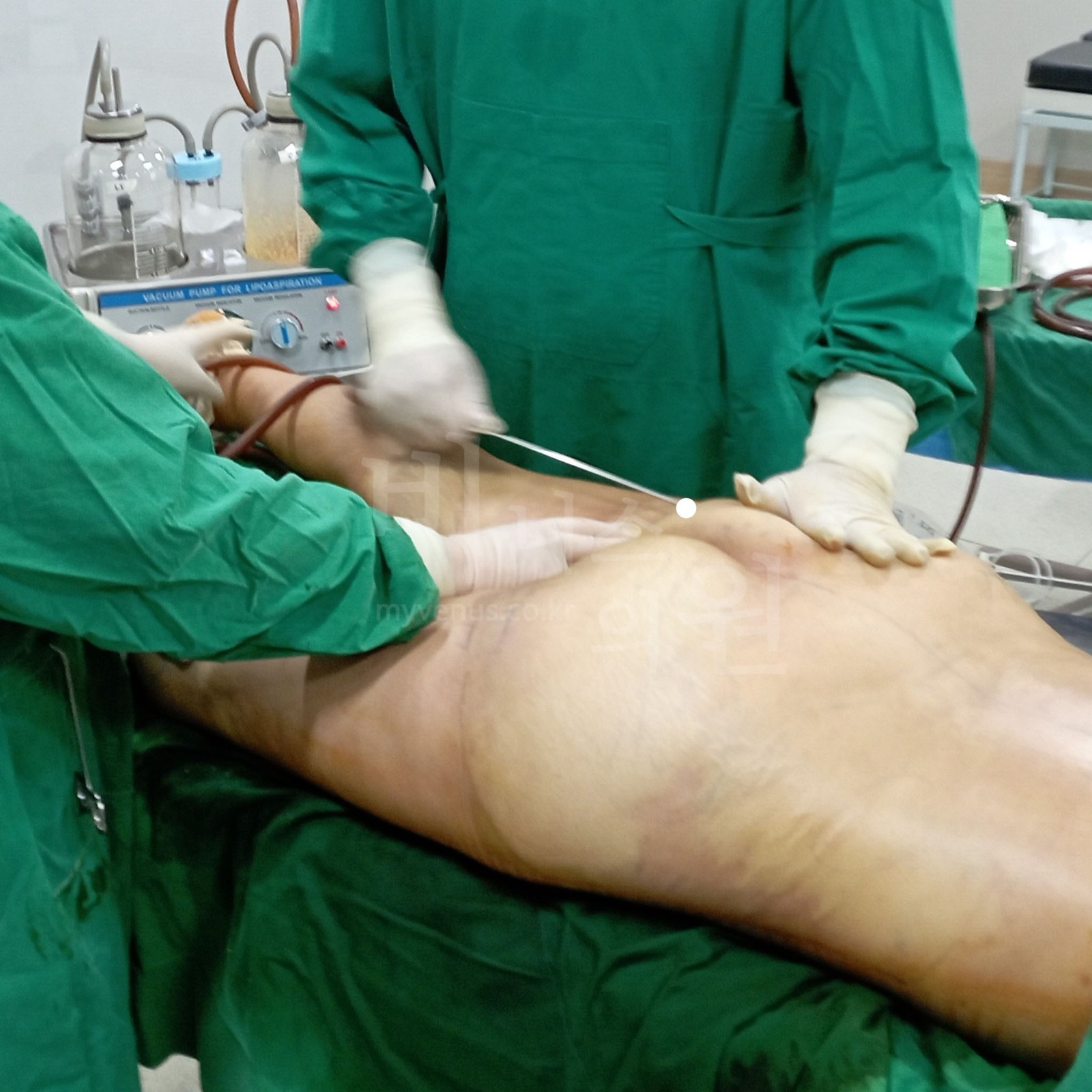Venus Clinic surgery scene — SAL liposuction of the buttock area with the cannula held in the hand