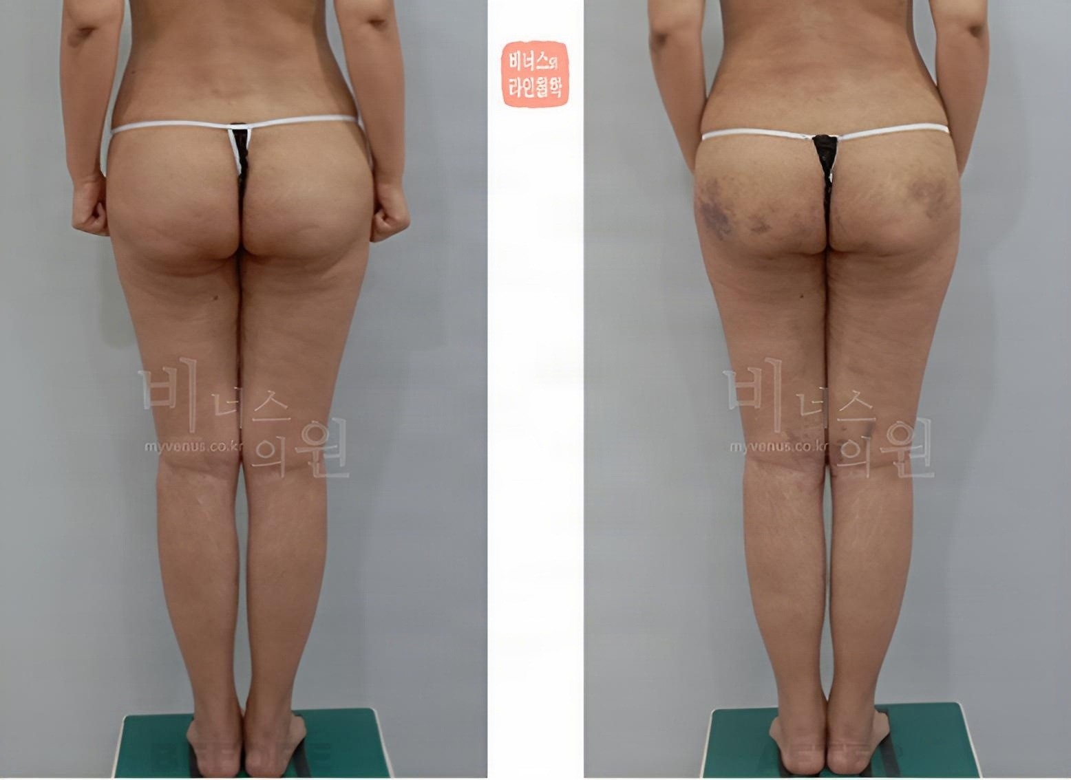 Buttock volume-up liposuction before-and-after photo, back view (about 2 weeks after surgery)