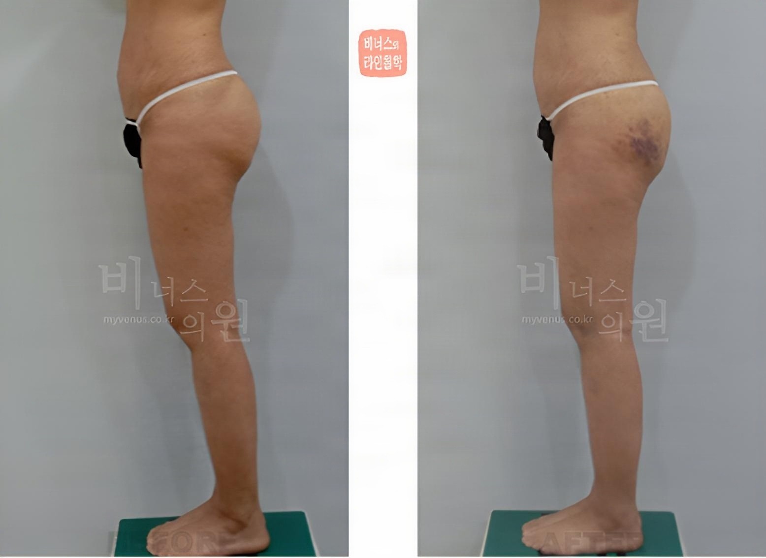 Buttock volume-up liposuction before-and-after photo, left side view (about 2 weeks after surgery)