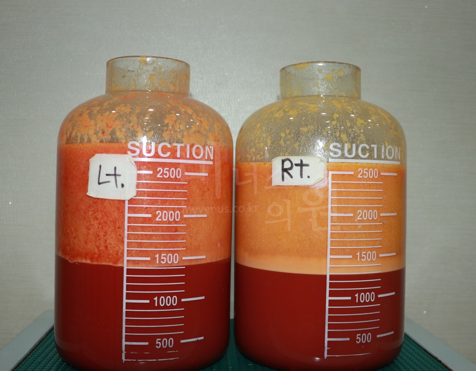 Fat removed on the day of surgery — left (Lt) and right (Rt) containers