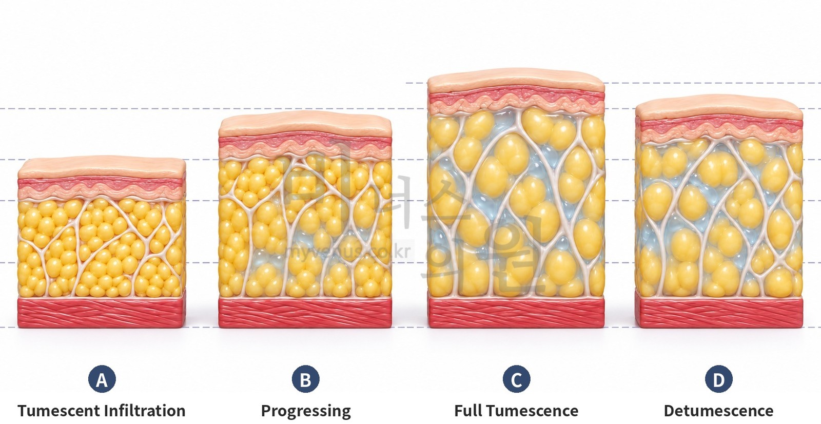 Schematic of the four stages in which the fat layer swells and then settles as tumescent solution is infused