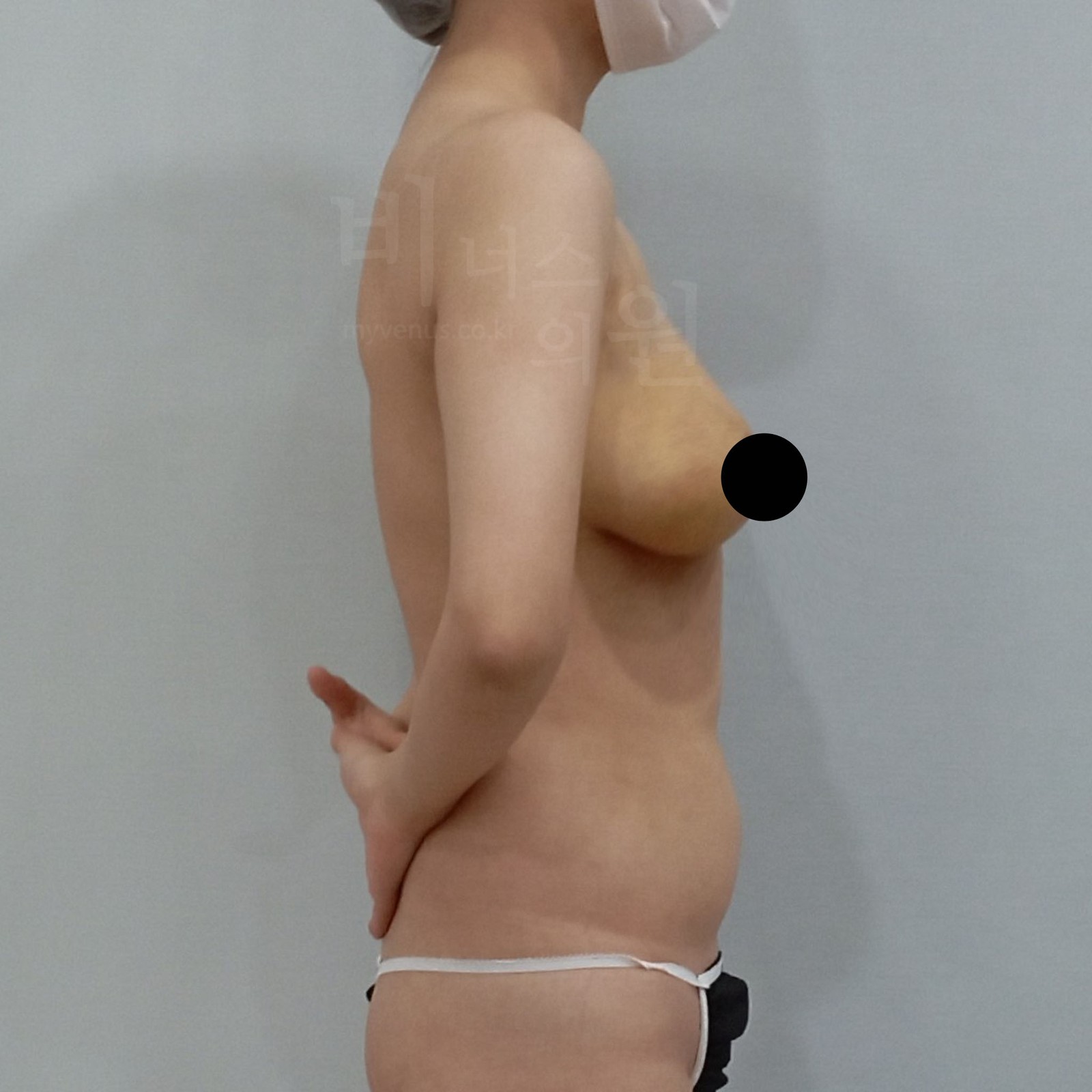 Breasts sagging after childbirth, one week after breast reduction liposuction, right side